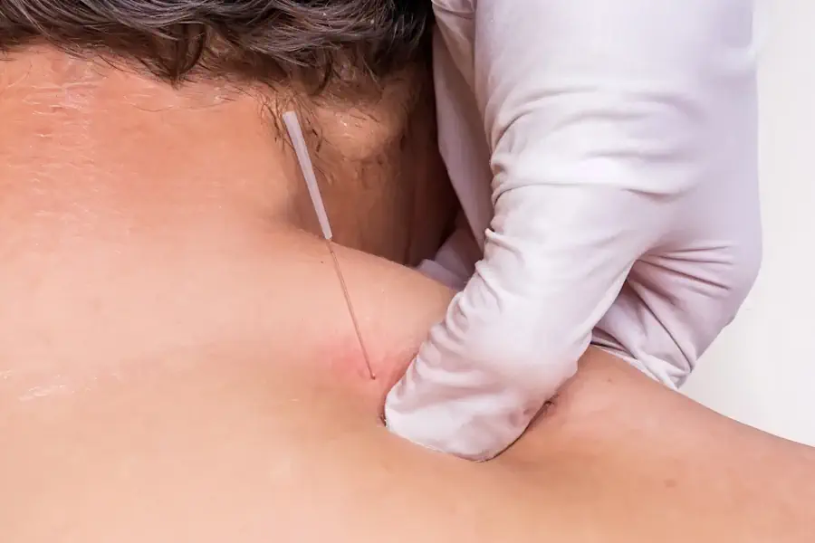 Dry Needling at kinetic myotherapy bundoora and northern suburbs5 post